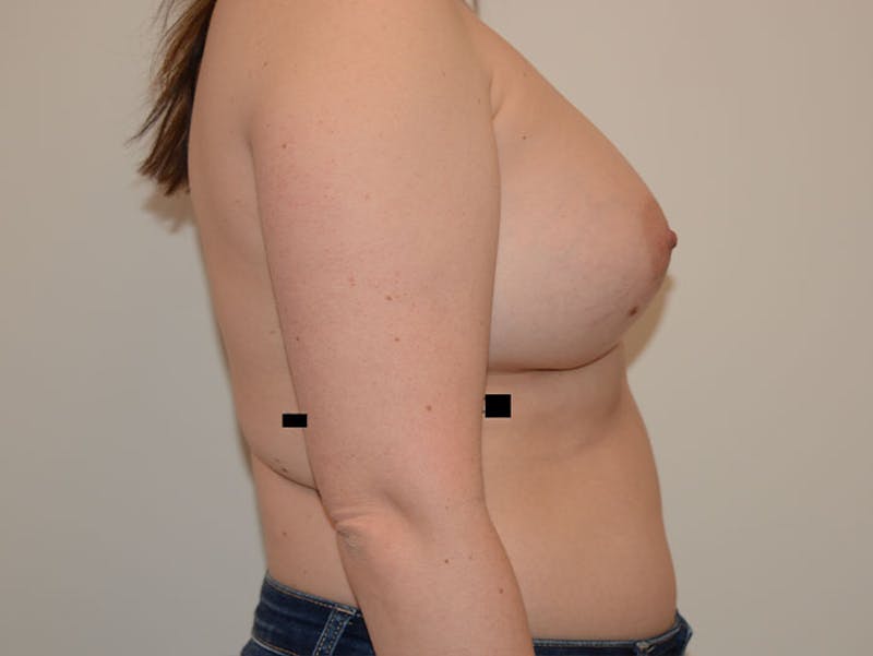 Breast Augmentation Before & After Gallery - Patient 12820080 - Image 4