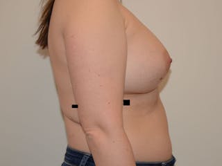 Breast Augmentation Before & After Gallery - Patient 12820080 - Image 4