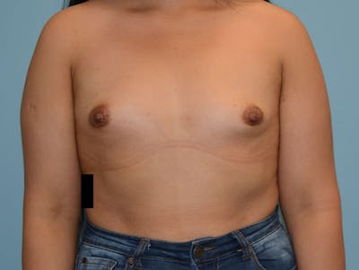 Breast Augmentation Before & After Gallery - Patient 12820083 - Image 1