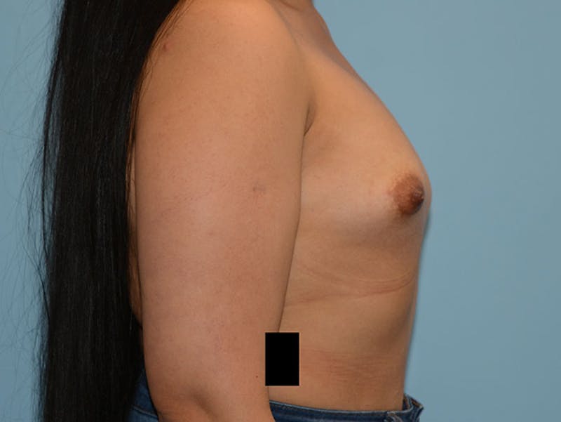 Breast Augmentation Before & After Gallery - Patient 12820083 - Image 3