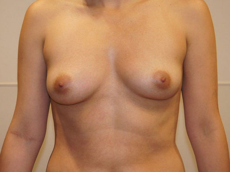 Breast Augmentation Before & After Gallery - Patient 12820091 - Image 1