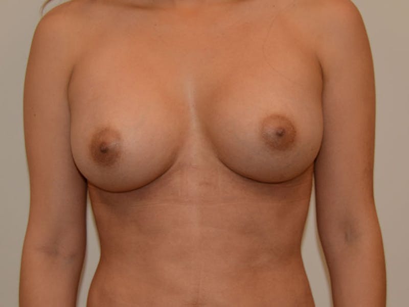 Breast Augmentation Before & After Gallery - Patient 12820091 - Image 2