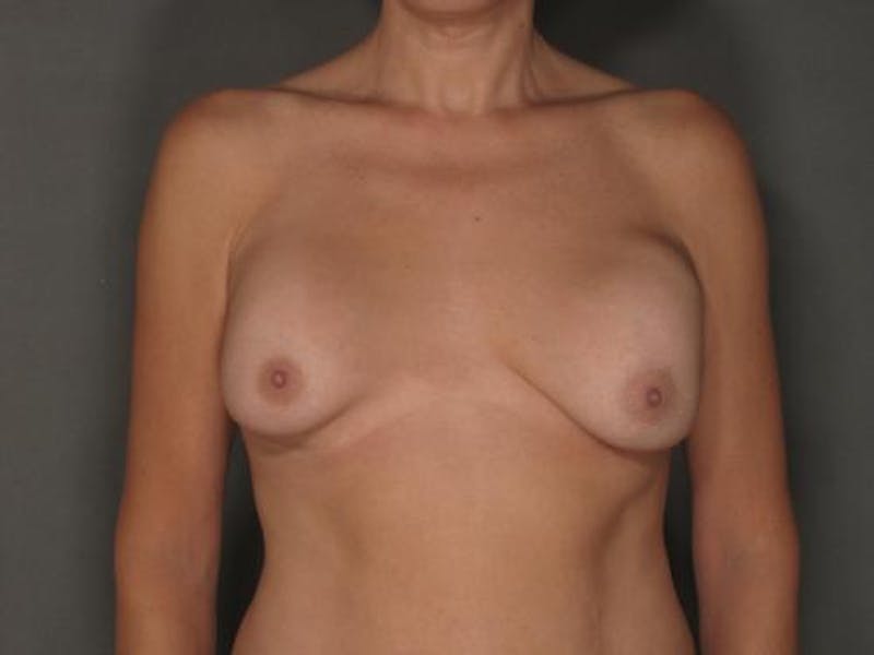Breast Revision Before & After Gallery - Patient 12861636 - Image 1
