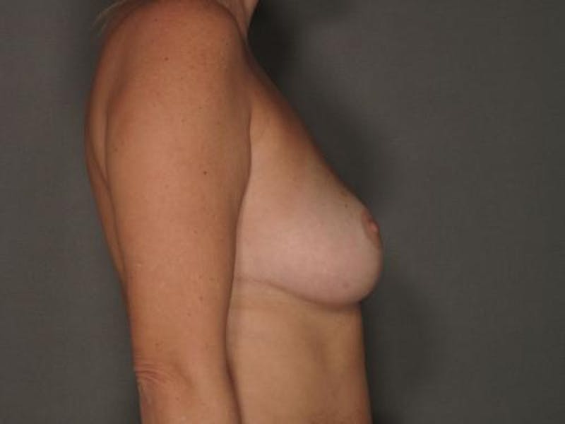 Breast Reduction Before & After Gallery - Patient 12861634 - Image 8
