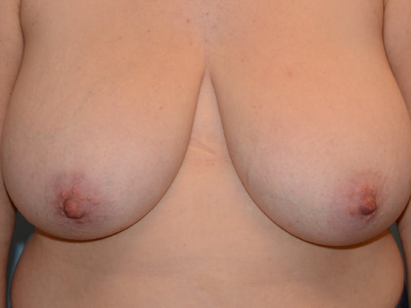 Breast Reduction Before & After Gallery - Patient 12861640 - Image 1