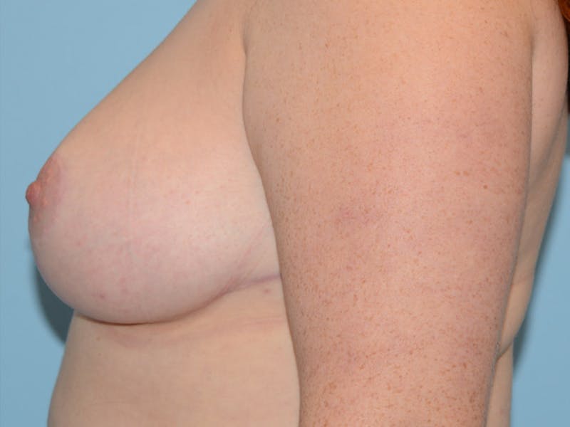 Breast Reduction Gallery - Patient 12861640 - Image 4