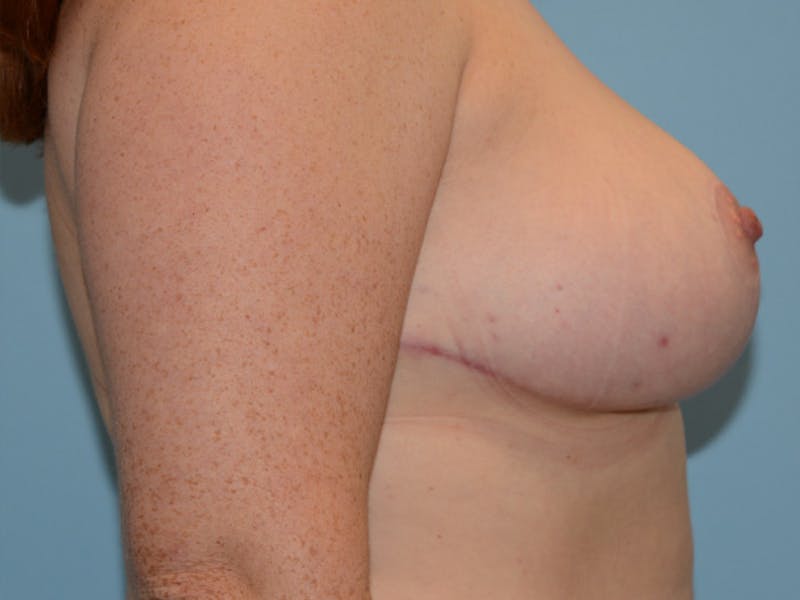 Breast Reduction Before & After Gallery - Patient 12861640 - Image 6