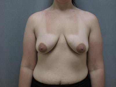 乳房抬高前后画廊-病人12861644 -图像1