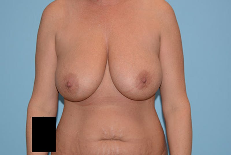 Breast Reduction Before & After Gallery - Patient 12861646 - Image 1