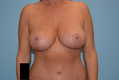 乳房缩小前后画廊-患者12861646 -图2