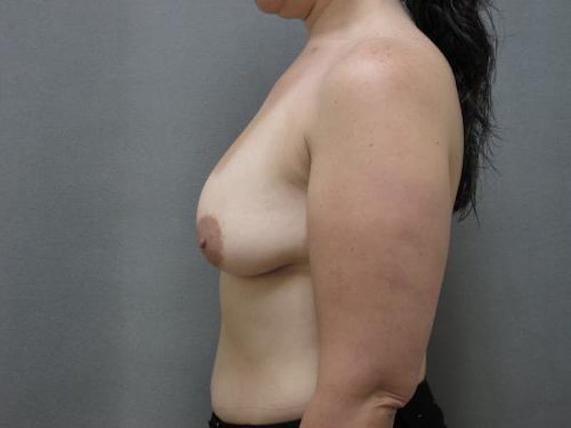 Breast Lift Before & After Gallery - Patient 12861644 - Image 5