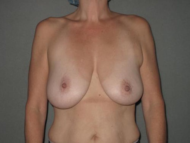 Breast Lift Before & After Gallery - Patient 12861648 - Image 1