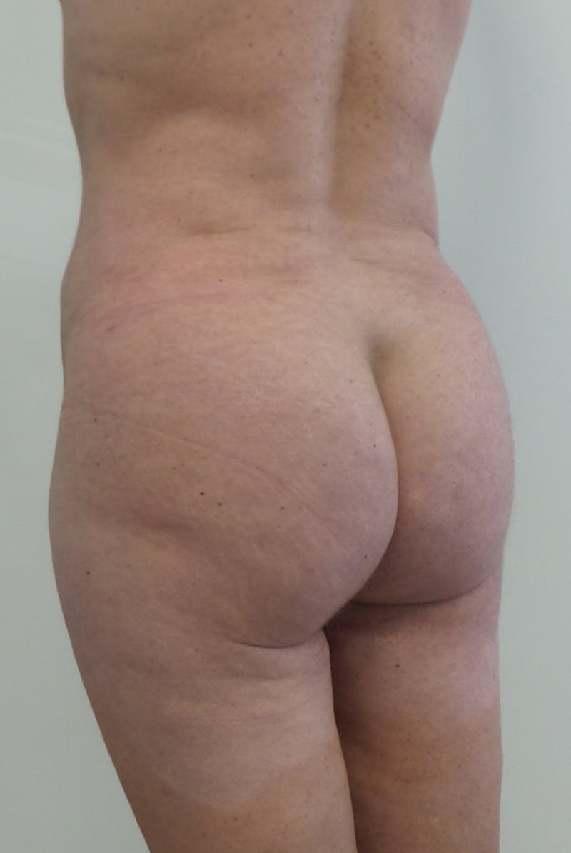 Brazilian Butt Lift Before & After Gallery - Patient 12861650 - Image 6