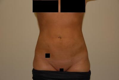 Liposuction Before & After Gallery - Patient 12861655 - Image 2