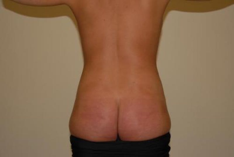 Liposuction Before & After Gallery - Patient 12861655 - Image 4
