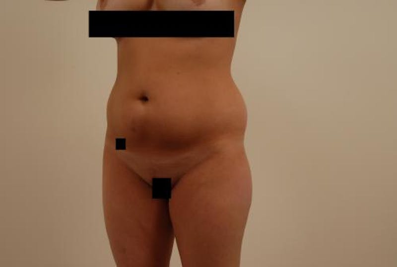 Liposuction Before & After Gallery - Patient 12861655 - Image 5