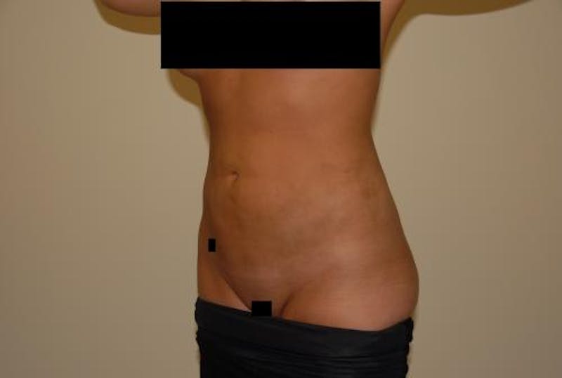 Liposuction Before & After Gallery - Patient 12861655 - Image 6
