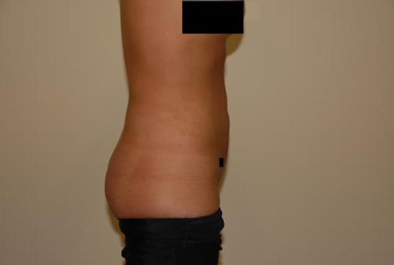 Liposuction Before & After Gallery - Patient 12861655 - Image 8