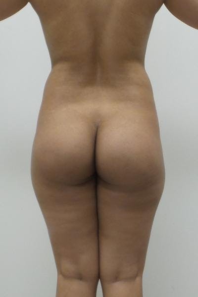 Brazilian Butt Lift Before & After Gallery - Patient 12861659 - Image 1