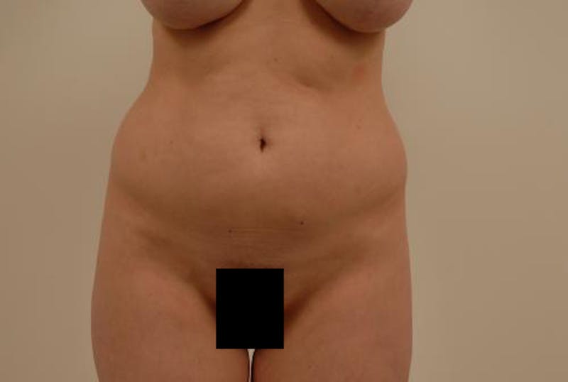 Liposuction Before & After Gallery - Patient 12861657 - Image 1