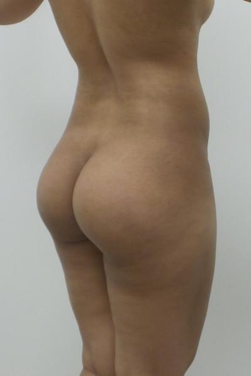 Brazilian Butt Lift Before & After Gallery - Patient 12861659 - Image 3