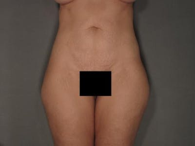 Liposuction Before & After Gallery - Patient 12861663 - Image 1