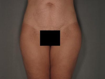 Liposuction Before & After Gallery - Patient 12861663 - Image 2