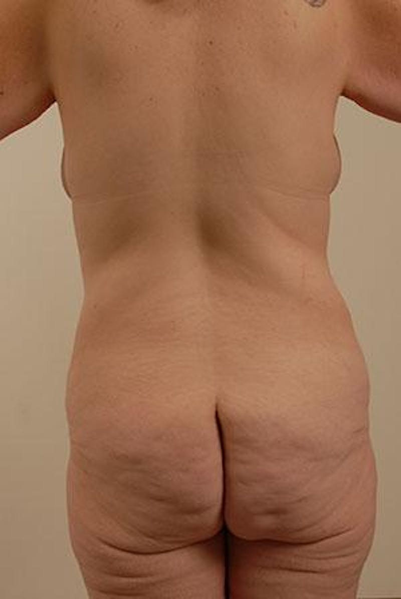 Lower Body Lift Before & After Gallery - Patient 12861662 - Image 7