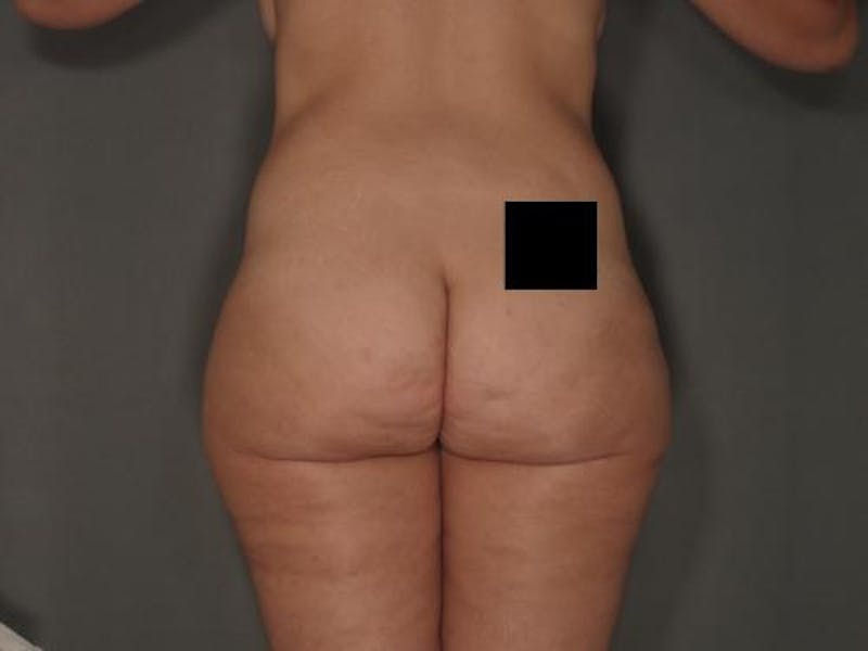 Liposuction Before & After Gallery - Patient 12861663 - Image 3