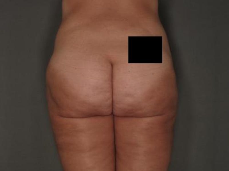 Liposuction Before & After Gallery - Patient 12861663 - Image 4