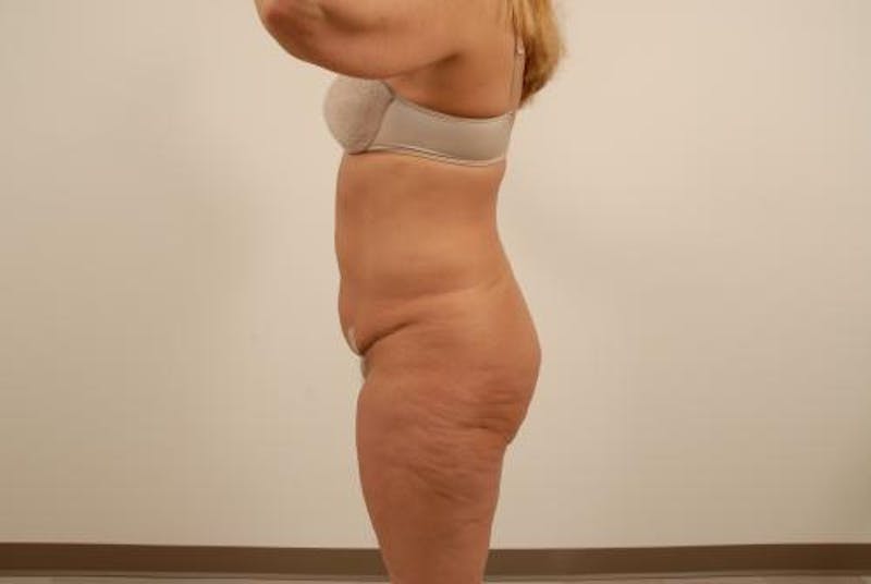 Lower Body Lift Before & After Gallery - Patient 12861695 - Image 5
