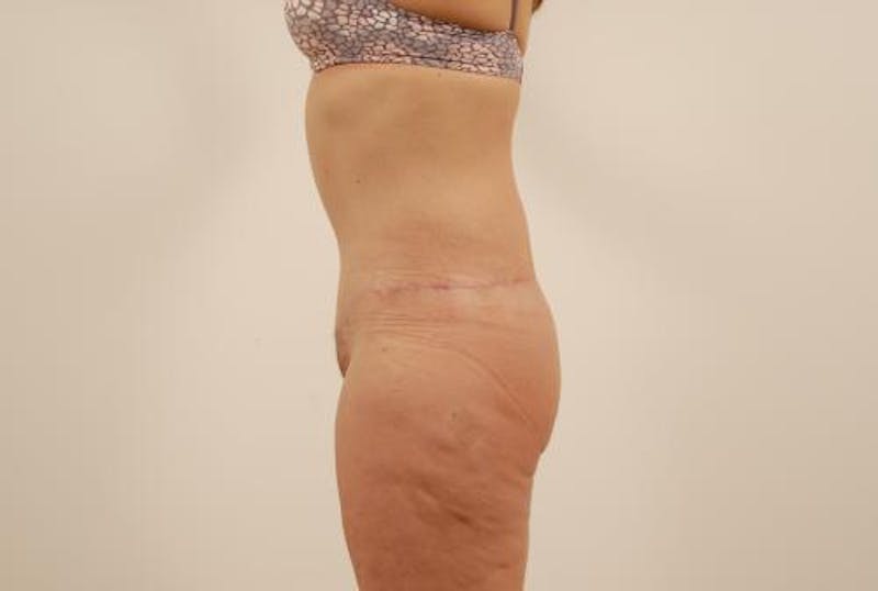 Lower Body Lift Before & After Gallery - Patient 12861695 - Image 6