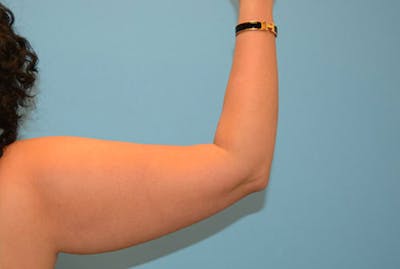 Arm Liposuction Before & After Gallery - Patient 12861694 - Image 1