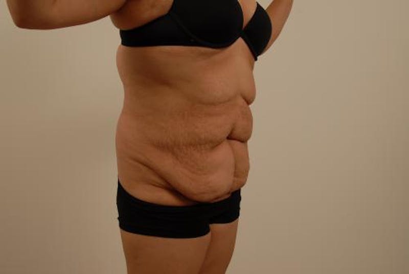 Tummy Tuck Gallery - Patient 12861698 - Image 7