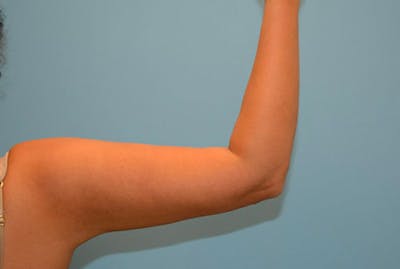 Arm Liposuction Before & After Gallery - Patient 12861694 - Image 2