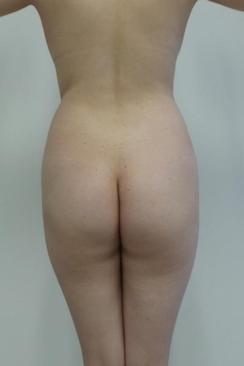 Brazilian Butt Lift Before & After Gallery - Patient 12861707 - Image 1