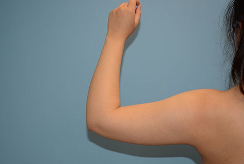 Arm Liposuction Before & After Gallery - Patient 12861697 - Image 1