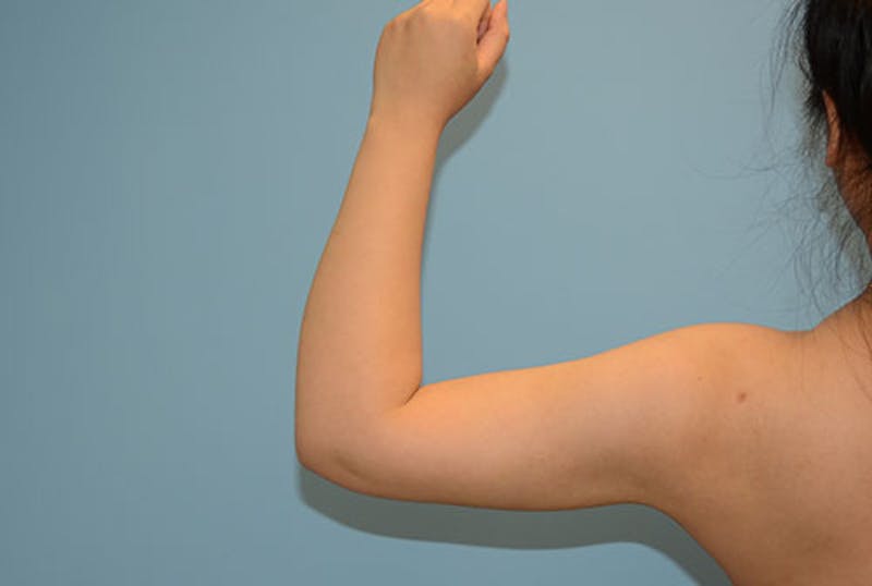 Arm Liposuction Before & After Gallery - Patient 12861697 - Image 2