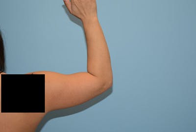 Arm Liposuction Before & After Gallery - Patient 12861699 - Image 1