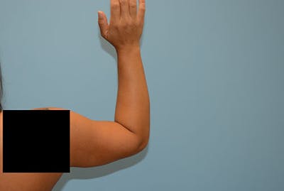 Arm Liposuction Before & After Gallery - Patient 12861699 - Image 2
