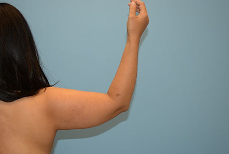 Arm Liposuction Before & After Gallery - Patient 12861701 - Image 1