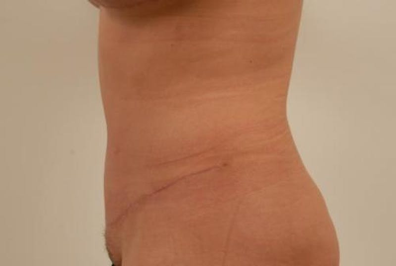 Tummy Tuck Before & After Gallery - Patient 12861702 - Image 4
