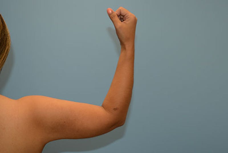 Arm Liposuction Before & After Gallery - Patient 12861701 - Image 2