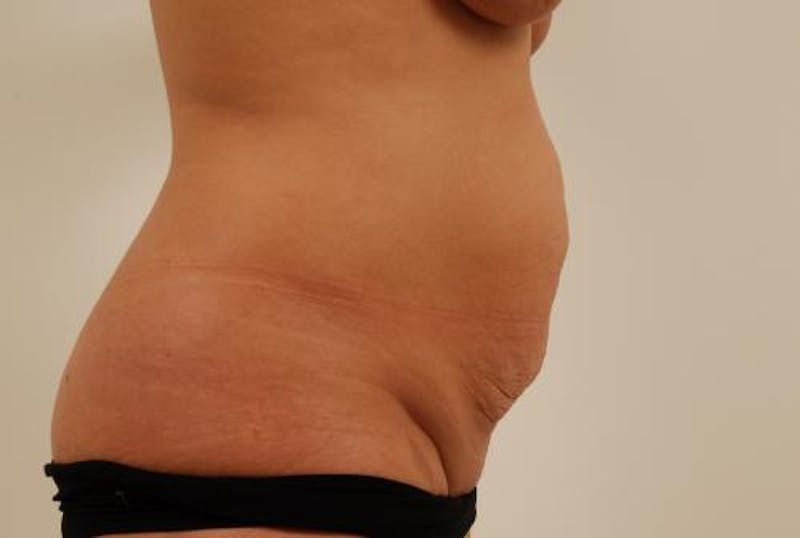 Tummy Tuck Before & After Gallery - Patient 12861702 - Image 5