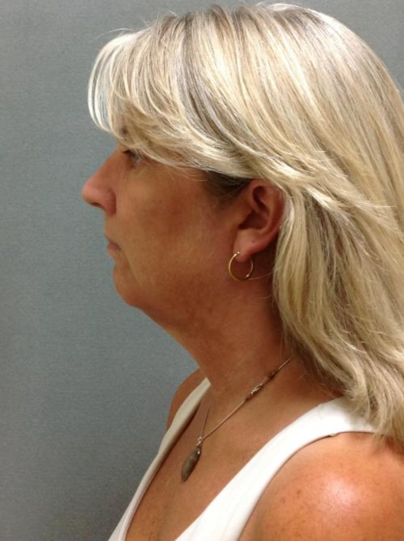 Facelift/Necklift Before & After Gallery - Patient 12861709 - Image 1