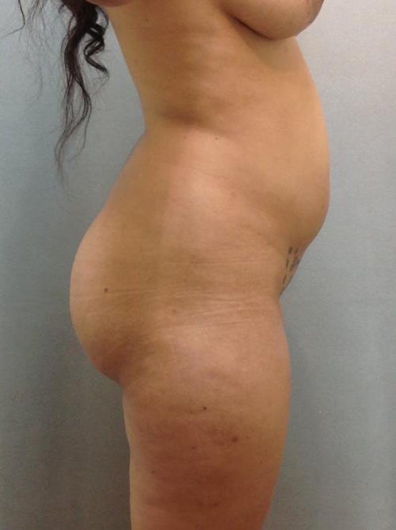 Liposuction Before & After Gallery - Patient 12861704 - Image 3