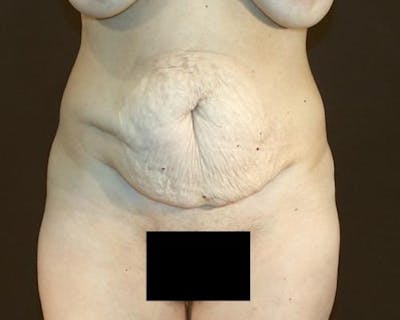 Tummy Tuck Before & After Gallery - Patient 12880228 - Image 1