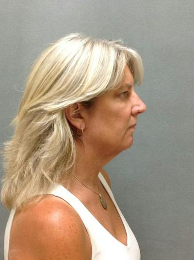 Facelift/Necklift Before & After Gallery - Patient 12861709 - Image 1