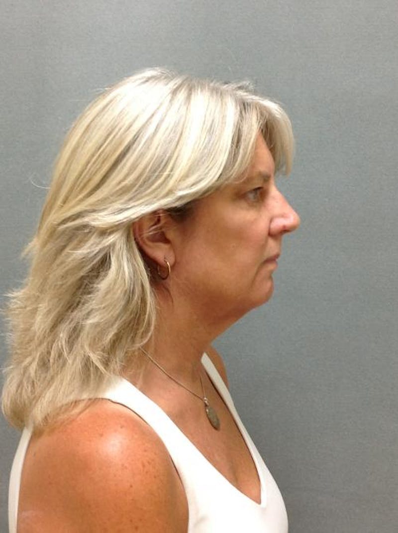 Facelift/Necklift Before & After Gallery - Patient 12861709 - Image 3