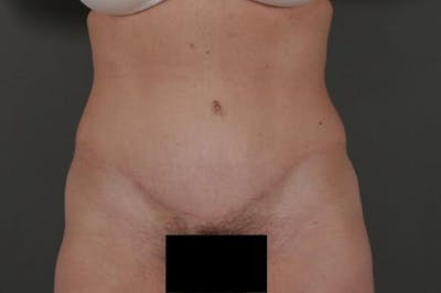 Tummy Tuck Before & After Gallery - Patient 12880228 - Image 2